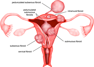 What are fibroids?